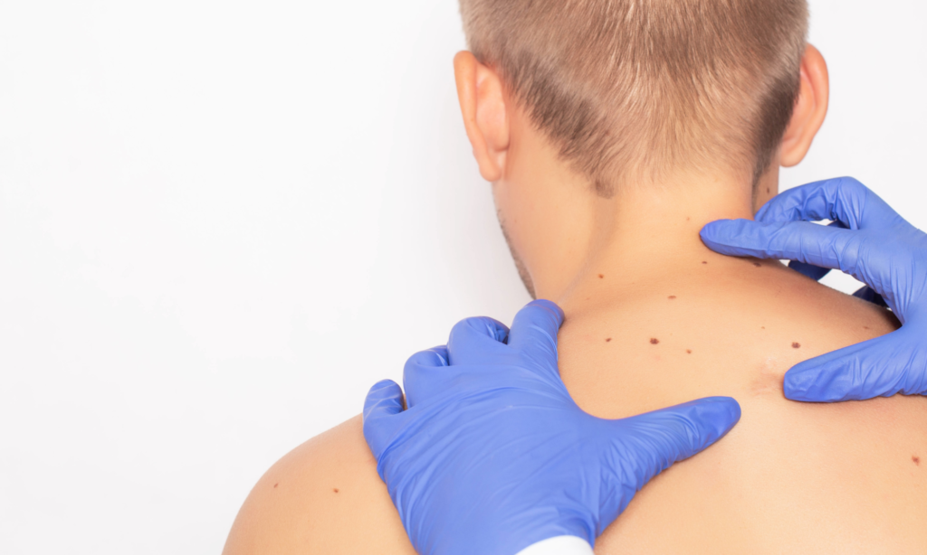 Types of Skin Cancer and When to Get Checked 3